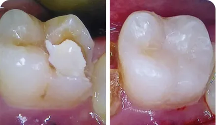 Direkte Klasse-II-Kompositrestaurierung eines endodontisch behandelten Zahns 36